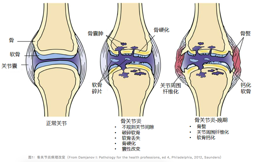 说“骨”道今，探讨骨关节炎的治疗新思路- 洞健